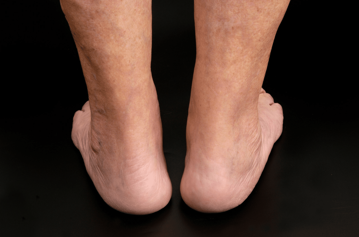 Photo montrant les cheville d un homme et ses talons - tendon calcaneen | Dr Jerome Auger Paris 16